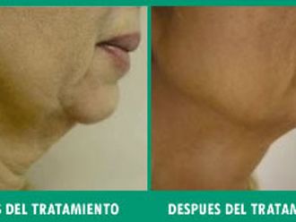 Rejuvenecimiento
