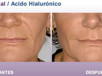 Relleno facial