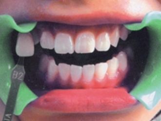 Est&eacute;tica dental