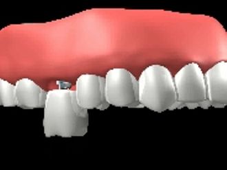 Implantes