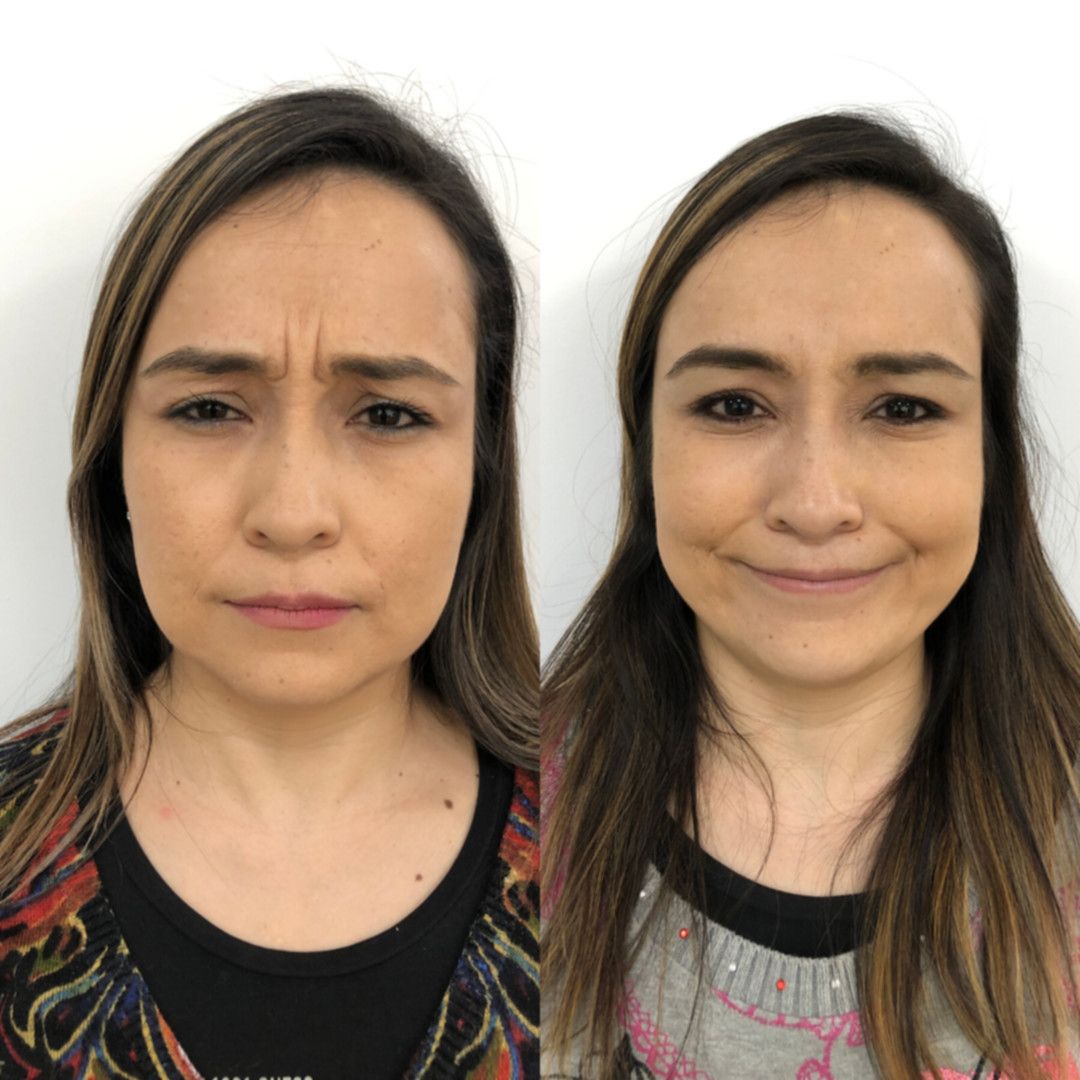 Antes y después Bótox
