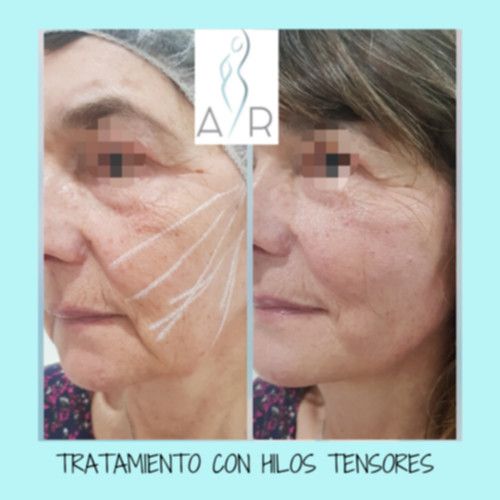 Antes y después tratamiento con hilos tensores