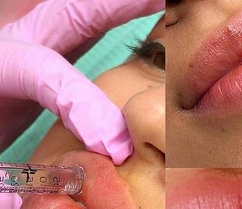 Funcionamiento Hyaluron Pen
