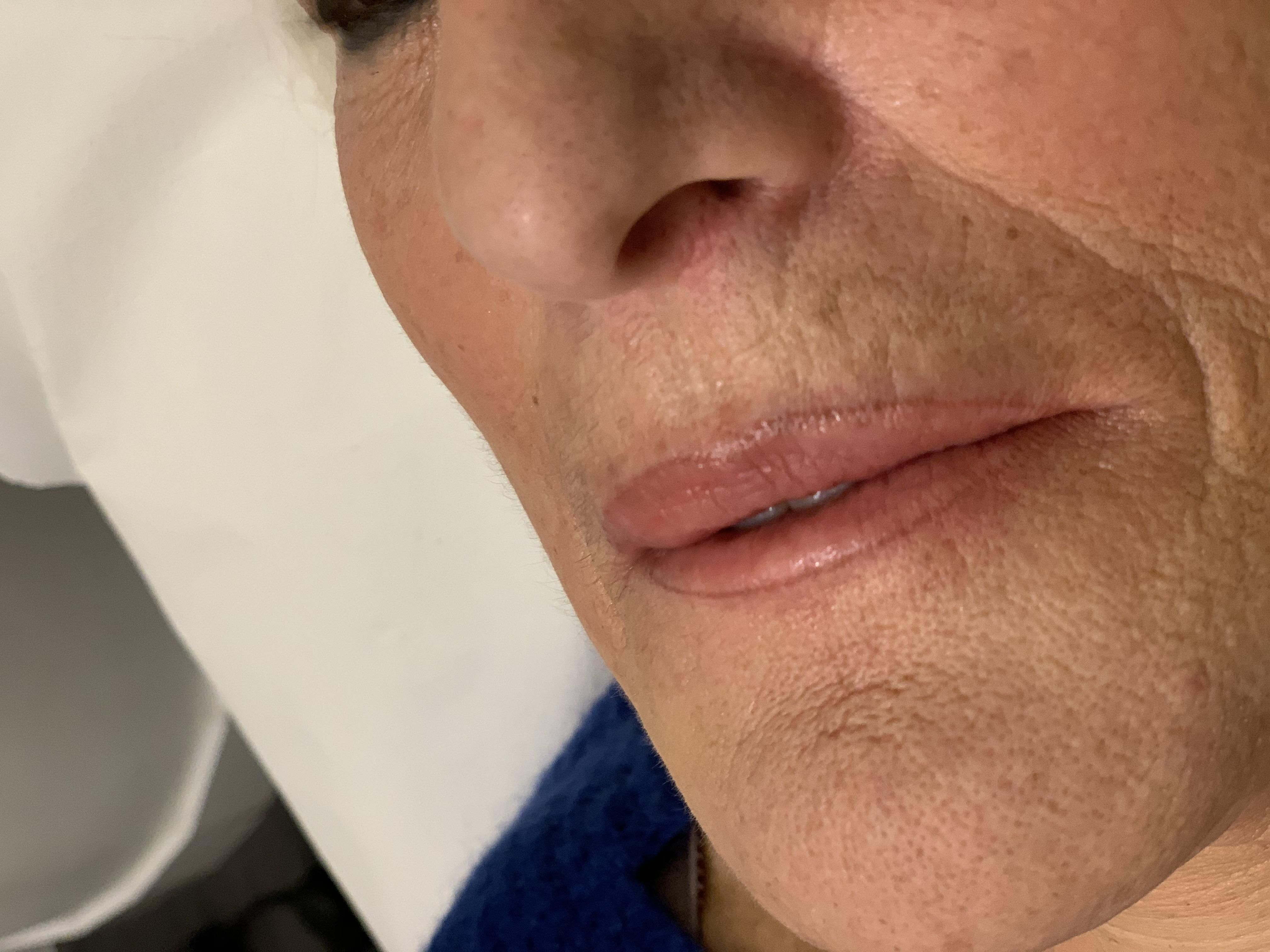 Resultados de la micropigmentación de labios