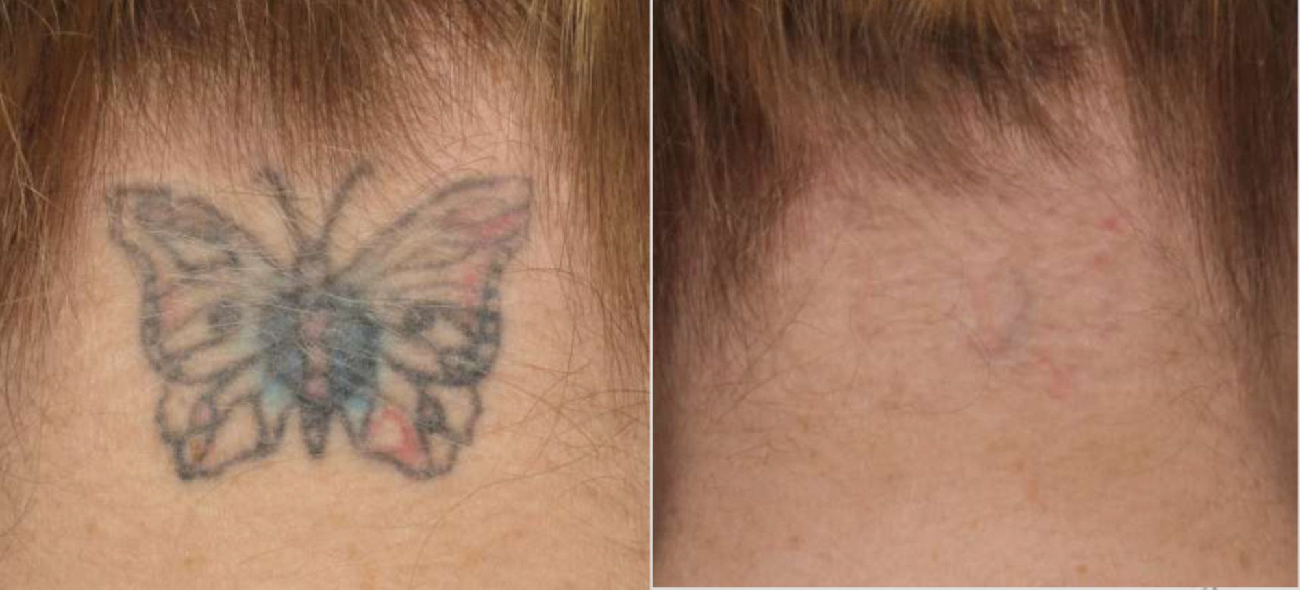 eliminacion-tatuaje.png
