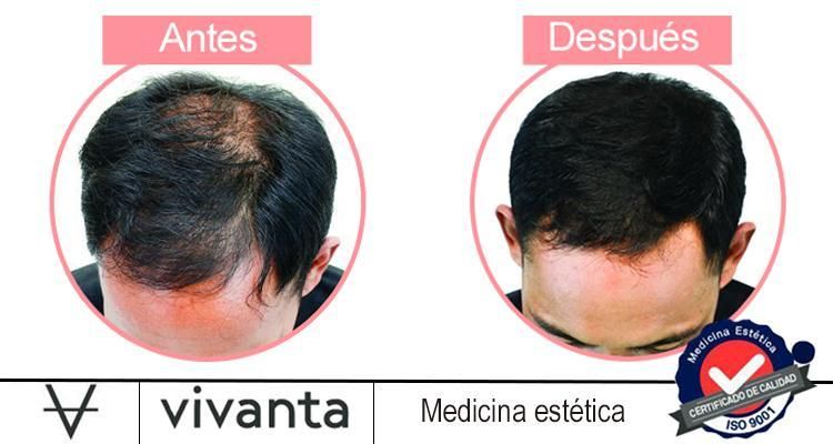 Injertos capilares