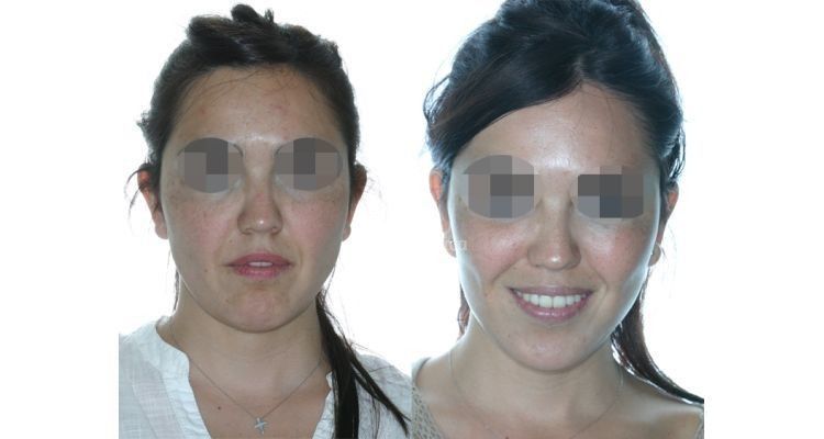 Antes y después de un lifting facial