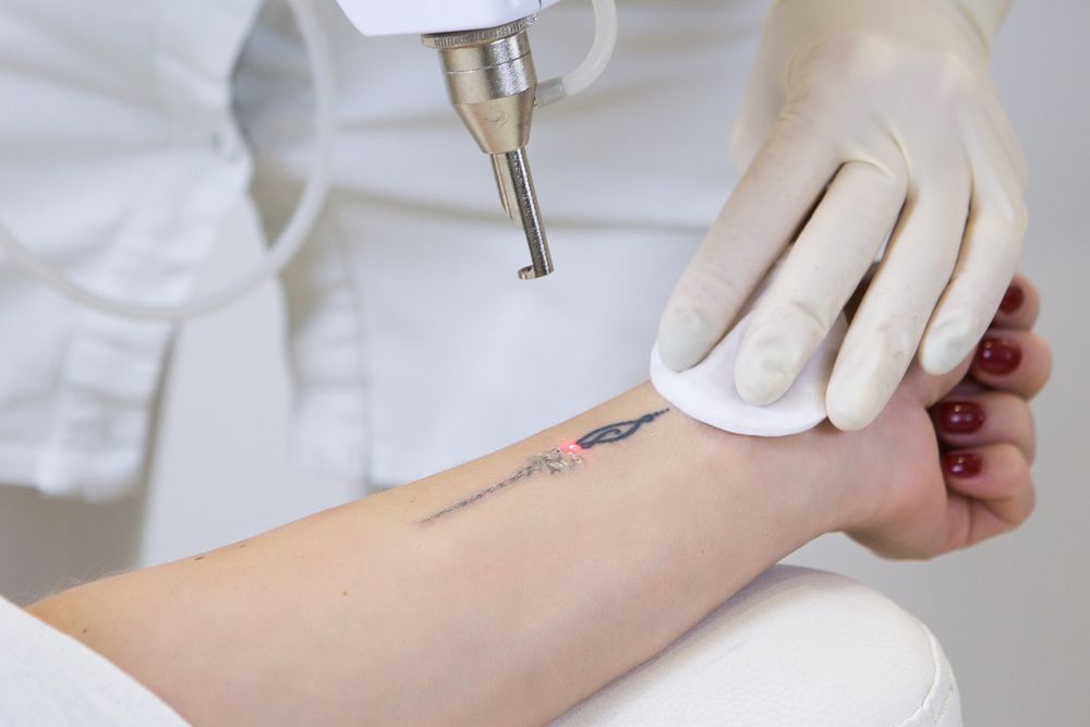 eliminar-tatuaje-laser-revlite.jpg