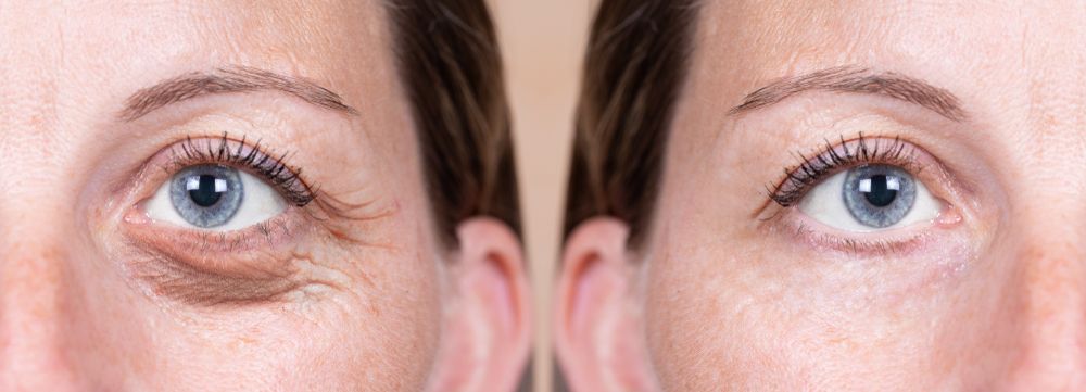 antes-y-despues-cirugia-blefaroplastia