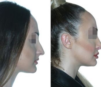 Antes y después de la rinoplastia ultrasónica
