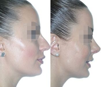 Antes y después de la rinoplastia ultrasónica