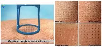 Pixelado de la piel en un tratamiento de resurfacing láser: máximo control y precisión.