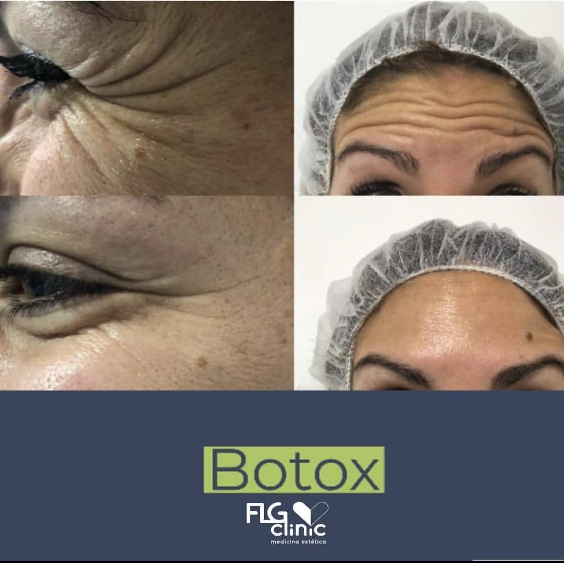 Antes y después bótox