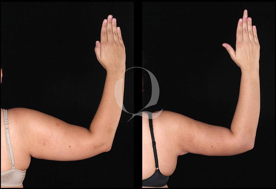 Antes y después Bodytite en brazos