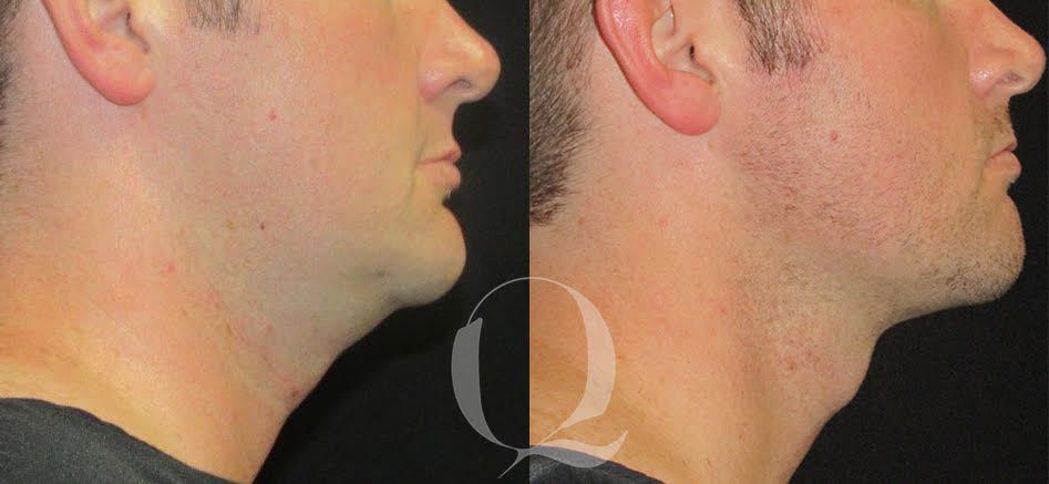 Antes y después Bodytite en cuello