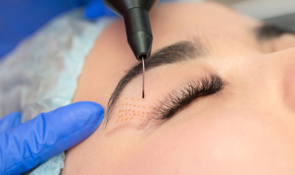 blefaroplastia-parpados-operacion.jpg