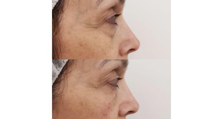 Antes y después ojeras con ácido hialurónico