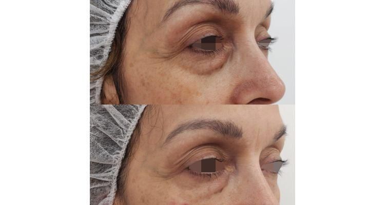 Antes y después ojeras con ácido hialurónico