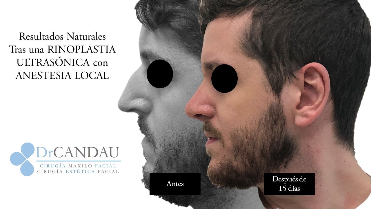 rinoplastia-ultrasonica-dr-alberto-canda