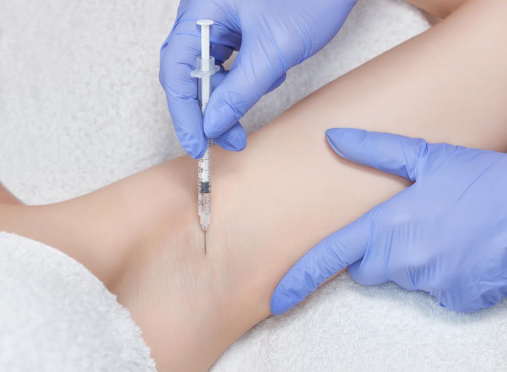 Tratamiento de bótox para la Hiperhidrosis