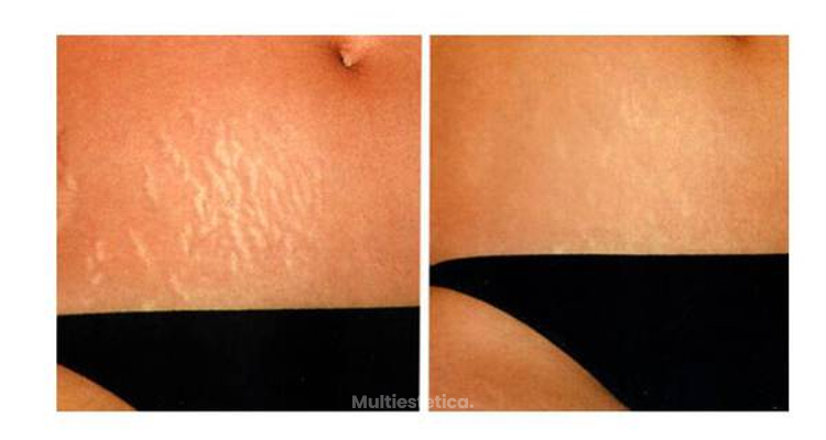 Eliminar estrias con laser barcelona
