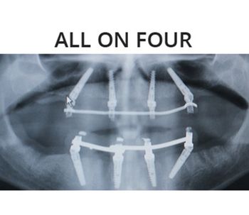 Tratamientos avanzados en implantología dental