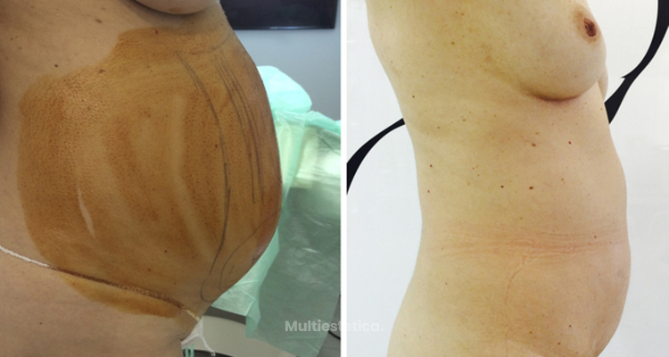Liposuction vaser antes y despues de adelgazar