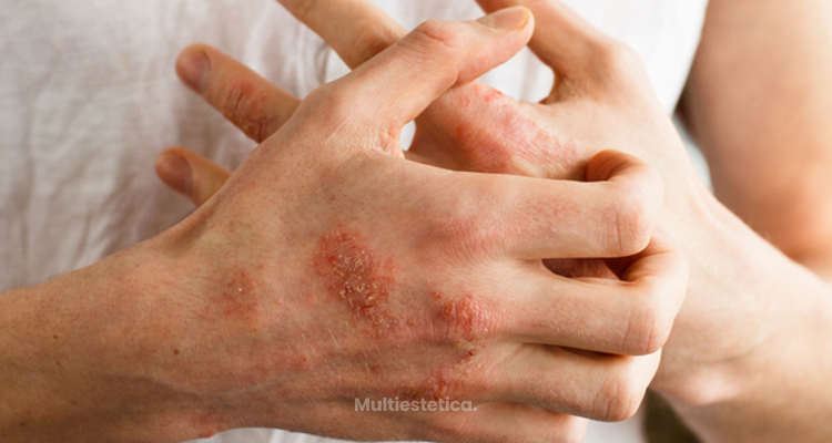 De por tipos estres dermatitis
