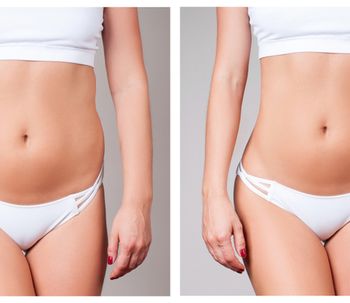 Cinco falsos mitos sobre la liposucción