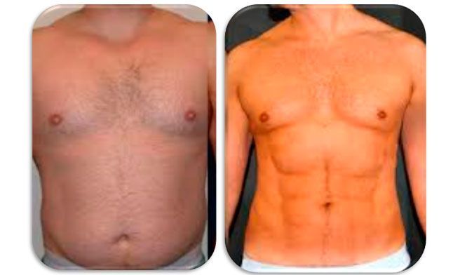 liposuccion-antes-y-despues-barcelona-005.jpg