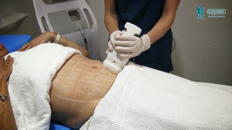 Testimonio De Maria Jose Sobre Hifu Corporal Y Otros 9027 Multiestetica Com